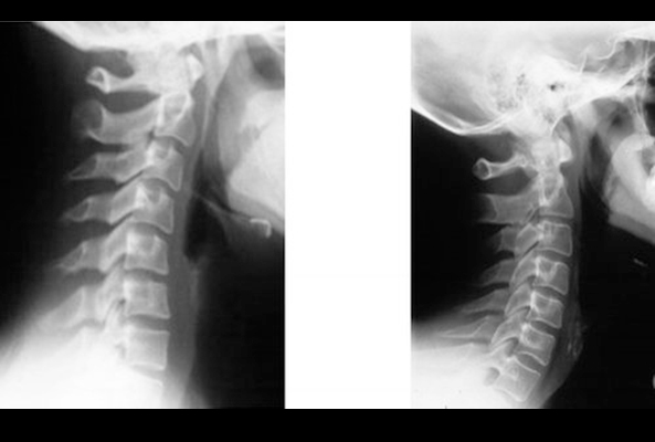 Chiropractic Frederick MD Neck X-ray
